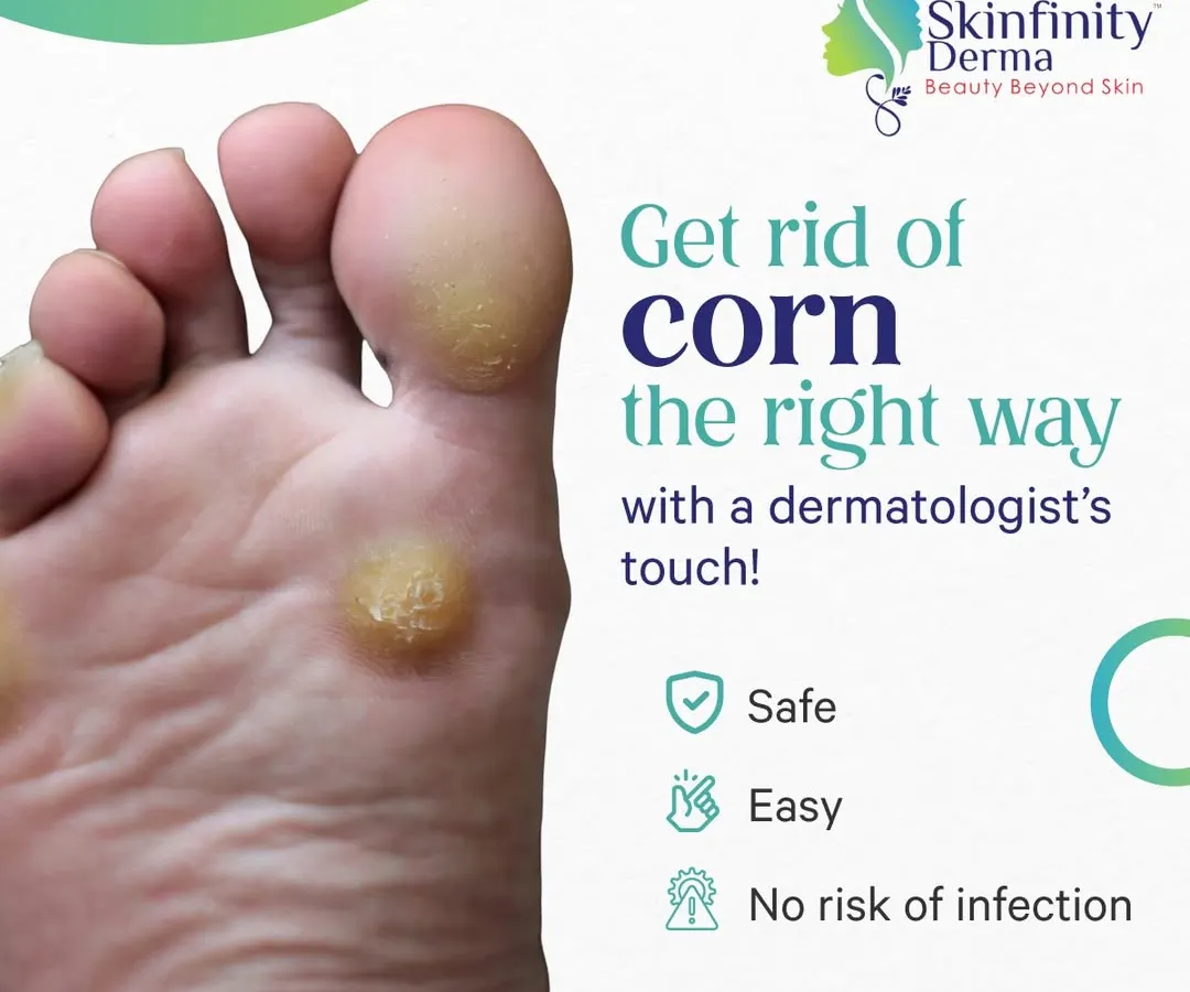 Painful corns on your feet can be a constant source of discomfort. We understand that over the counter solutions often fail to provide lasting relief. We focus on safe and effective clinical corn removal to not only treat the issue but also advise on how to prevent it from coming back.