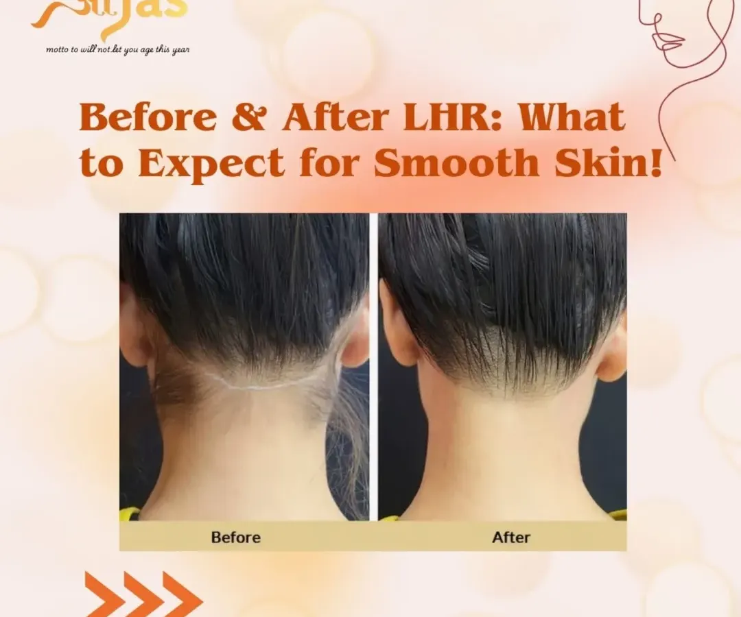 This is a perfect example of how laser hair reduction can clean up the neckline. The treatment effectively targets unwanted hair, resulting in a sharper, cleaner look with significantly reduced growth, eliminating the need for frequent shaving or trimming.