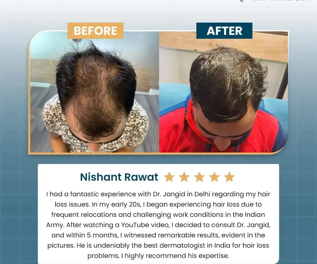 Real results speak louder than words. This is Nishant's story, who came to me with hair loss issues he faced while in the army. With a personalized non-surgical treatment plan, we achieved these remarkable results in just five months, significantly improving hair density and coverage.