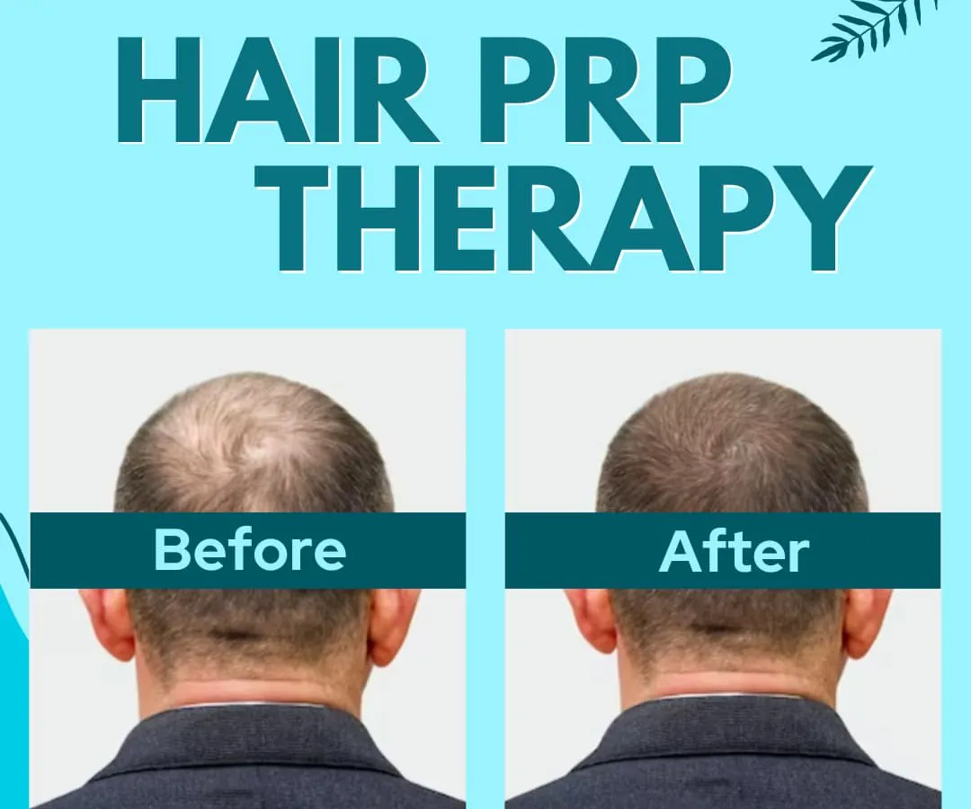 This before and after image shows the real results of our Hair PRP Therapy. We use the body's own healing properties to significantly reduce hair loss and promote new, healthy growth.