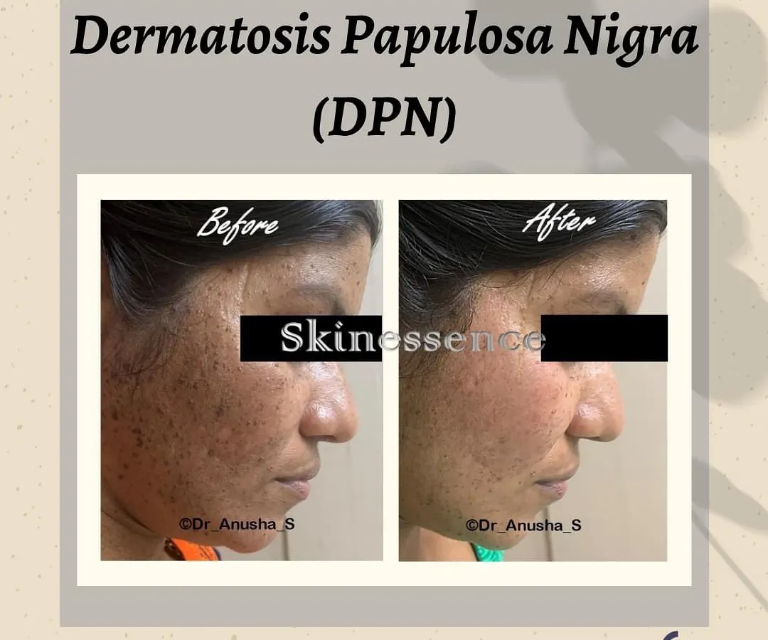 Here is a clear before and after example of Dermatosis Papulosa Nigra (DPN) treatment. These common, harmless growths on the face can be a significant cosmetic concern. Using precise removal techniques, I can achieve clear, smooth skin for my patients, as seen in this transformation.