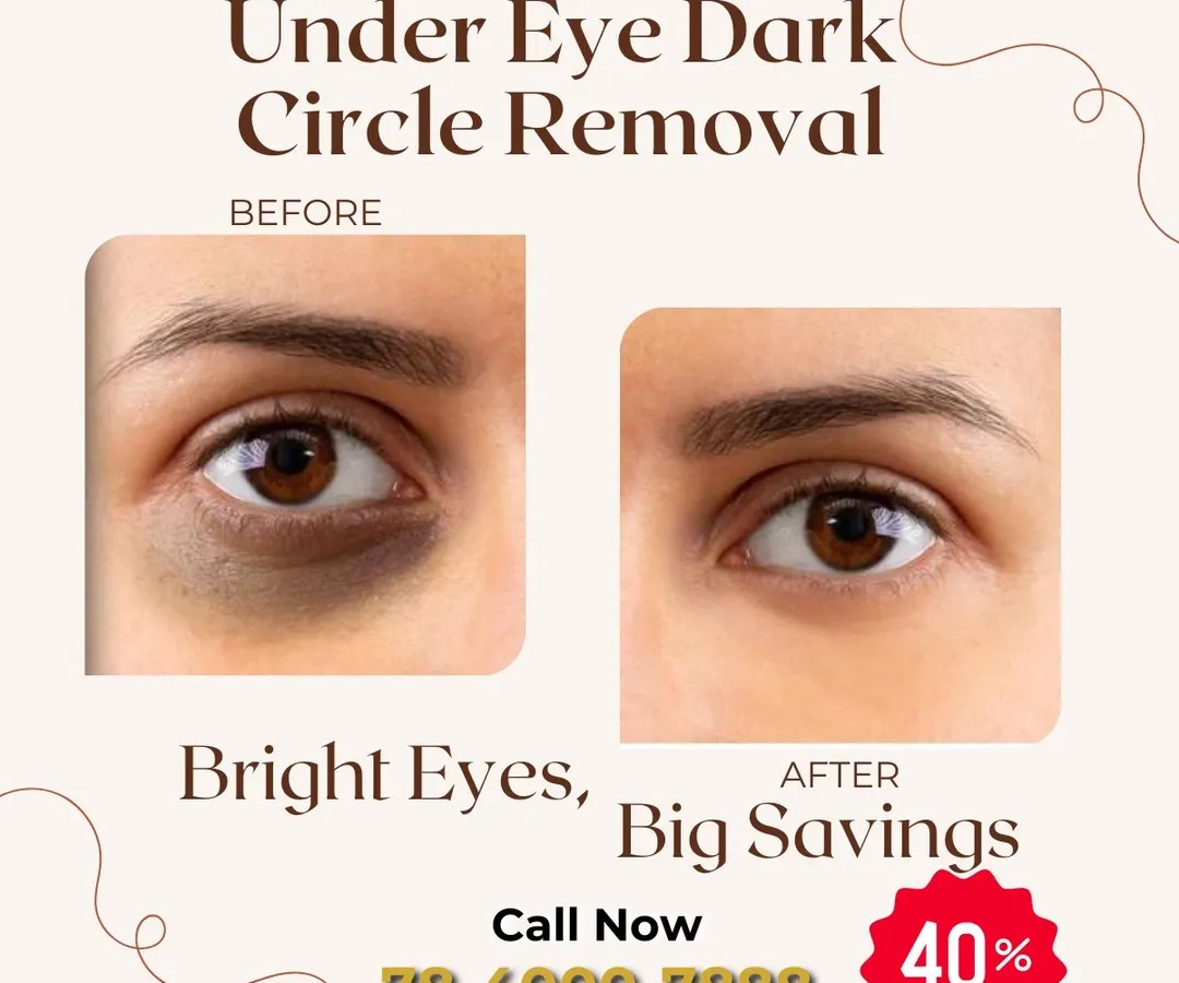 This before and after comparison highlights our success in treating one of the most common concerns: under-eye dark circles. The result is a brighter, more refreshed appearance, achieved through a personalized treatment plan designed to restore skin tone and texture.