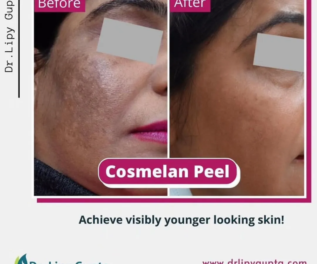 Here you can see the powerful results of a Cosmelan Peel. This medical-grade treatment is one of my go-to solutions for stubborn pigmentation and melasma. Notice the significant reduction in dark spots and the overall improvement in skin clarity and texture, revealing visibly brighter and more even-toned skin.