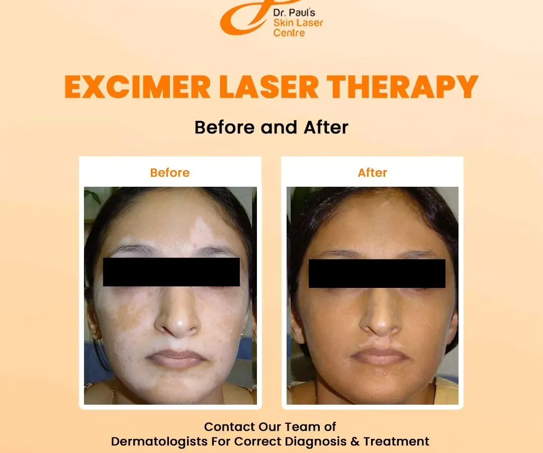 This patient saw a significant restoration of skin color on her face after undergoing Excimer laser therapy. This treatment is highly effective for targeting specific, stubborn patches of vitiligo by using a focused beam of light to stimulate repigmentation.