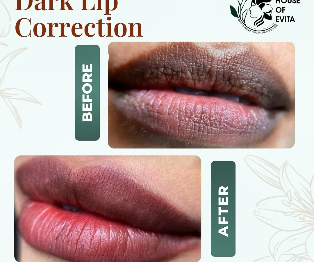 This is a life-changing Dark Lip Correction. I carefully neutralized the cool, dark tones to reveal a brighter, more even, and naturally rosy color. This semi-permanent treatment eliminates the need for constant lipstick application.