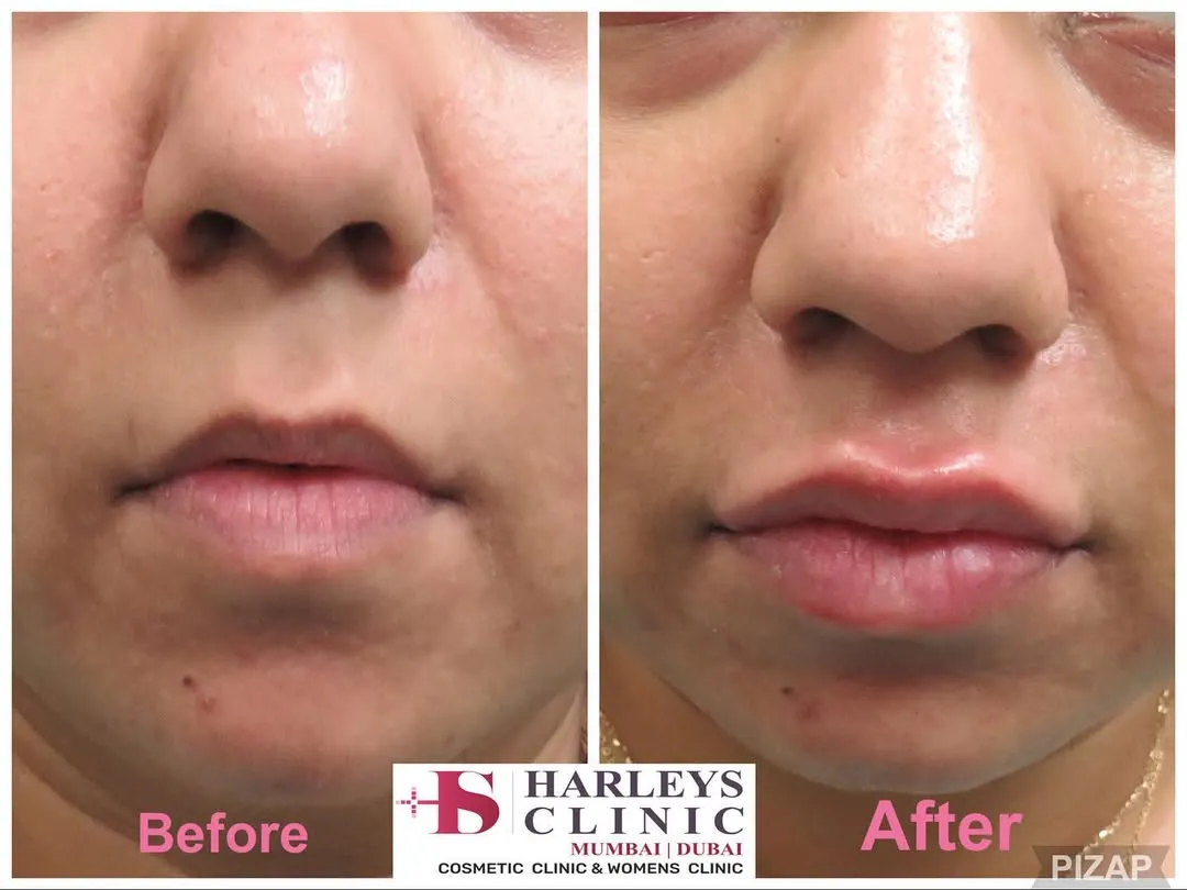 This before and after shows how I use hyaluronic acid fillers for subtle lip enhancement. My goal is to add volume and definition that complements your natural facial structure, resulting in a refreshed and balanced appearance, not an overdone look.