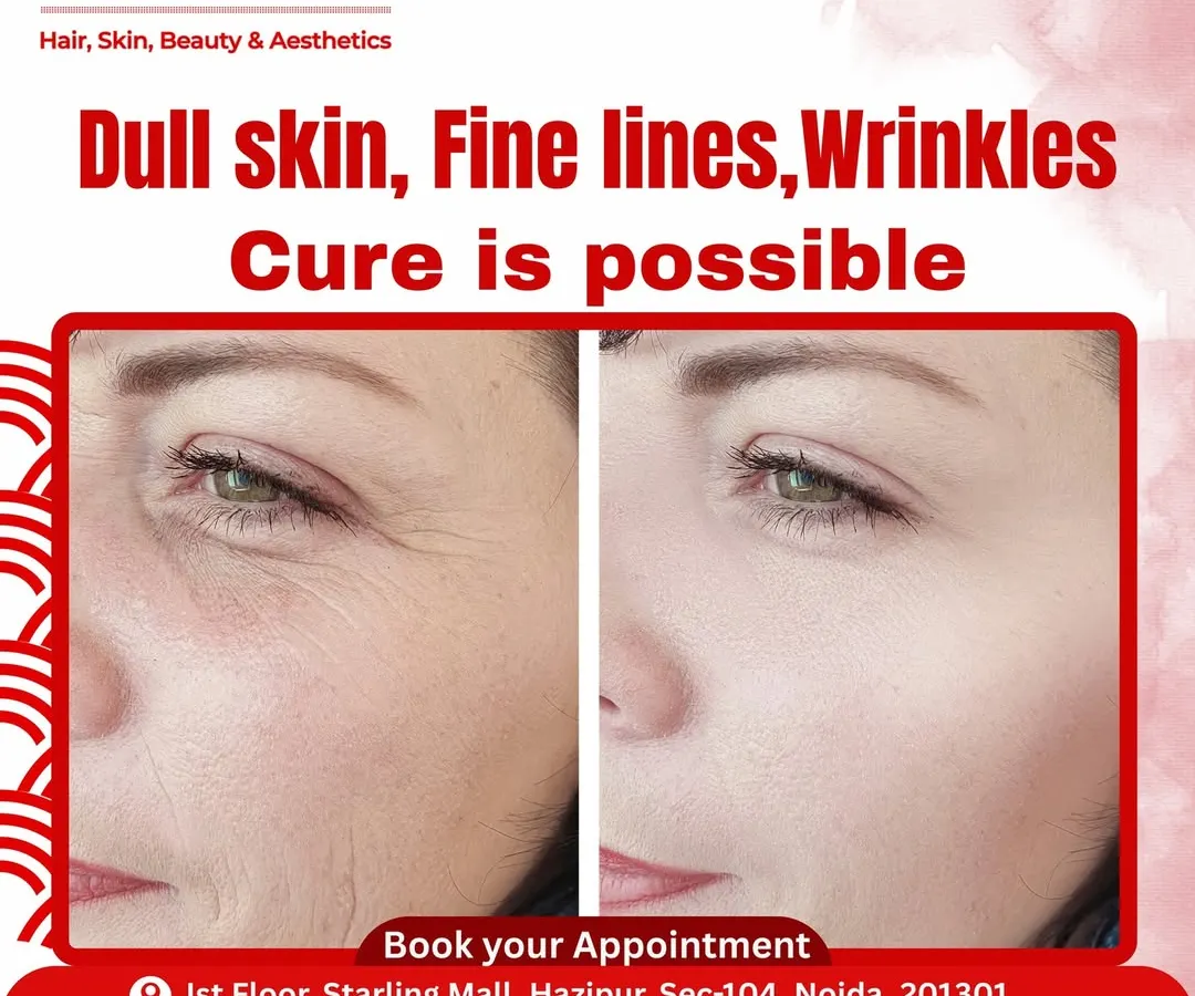 This is the result of our personalized anti-aging strategy. We effectively smoothed fine lines and wrinkles and restored a youthful glow by focusing on deep skin repair and rejuvenation. This transformation shows how we tackle the signs of aging for visibly smoother, brighter skin.