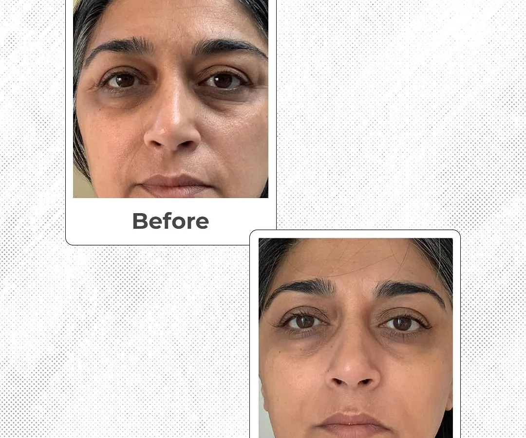 This is a real result from one of my patients. We focused on reducing under-eye wrinkles and fine lines for a fresher, more rested appearance. My goal is always to provide natural-looking anti-aging results that restore your confidence.