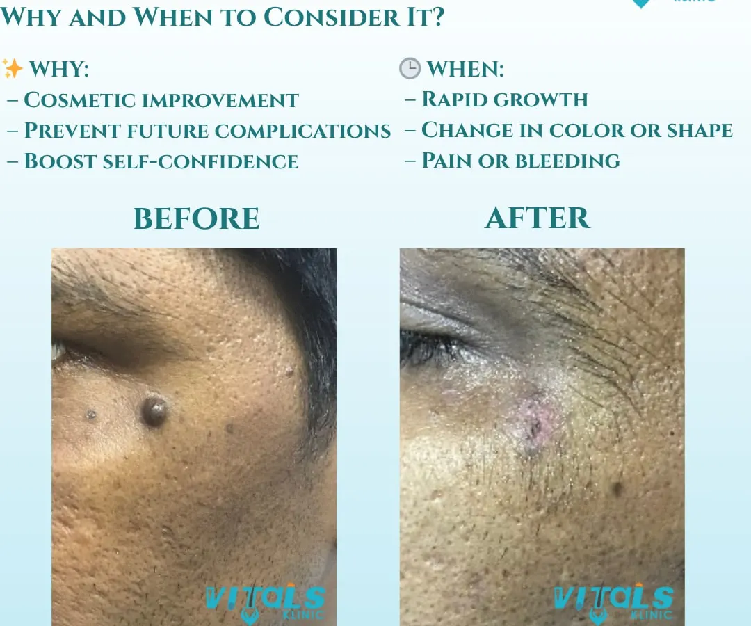 This before-and-after image shows the result of a facial mole removal. I perform this procedure for both cosmetic improvement and to address any medical concerns, ensuring minimal scarring and a smooth outcome.