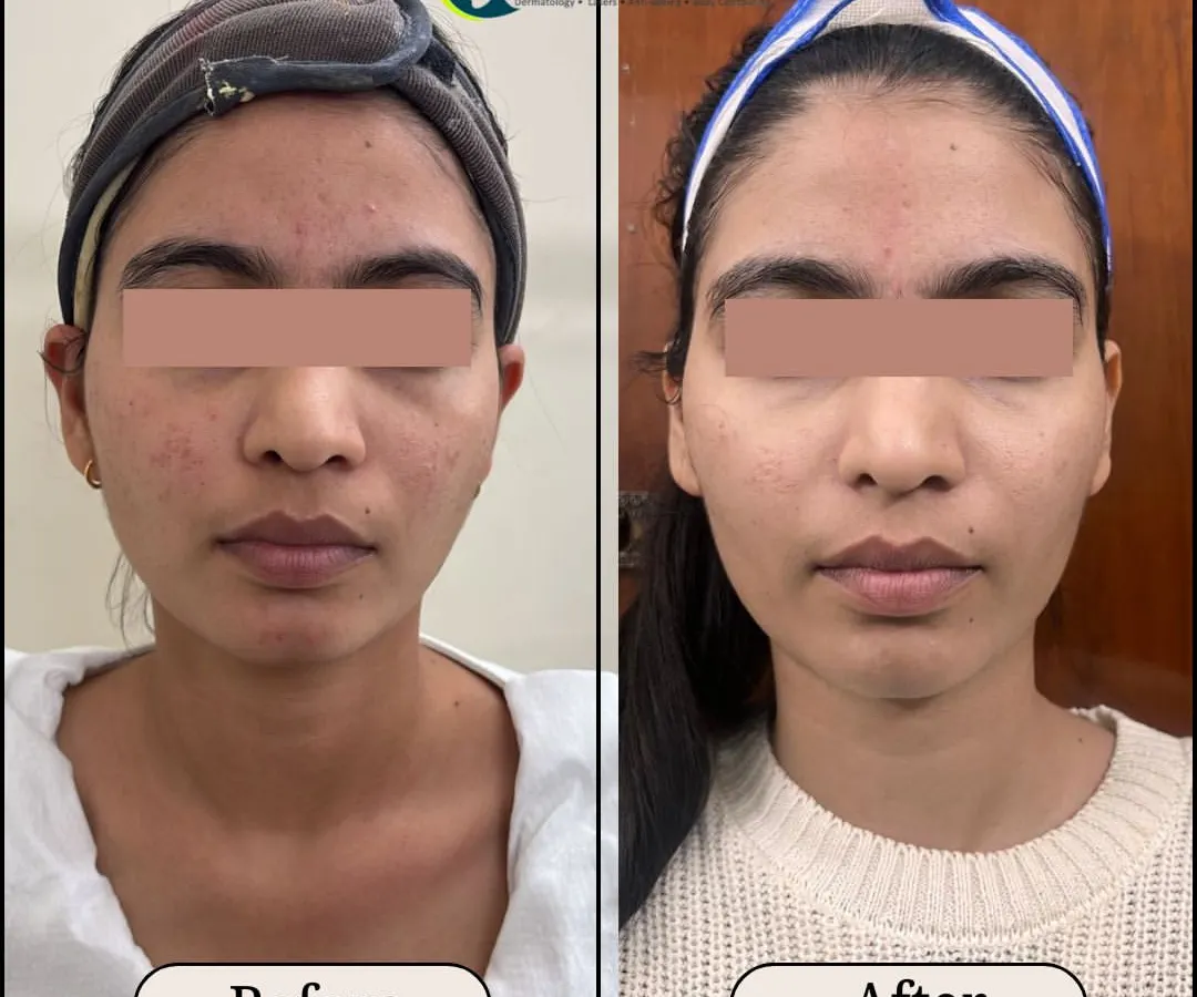 This is a great example of the skin transformation possible with Morpheus8. You can see a visible reduction in acne marks and a significant improvement in overall skin texture and jawline definition after the treatment.