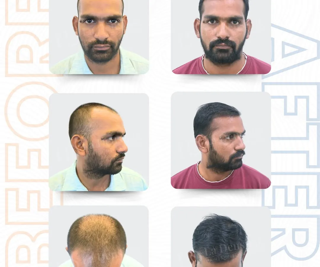 This is what a complete transformation looks like. For Mr. Durgesh, I used the RT-FUE Sapphire technique to place 3,447 grafts. We addressed the receding hairline, the thinning sides, and the crown area to create a full, natural look from every angle.
