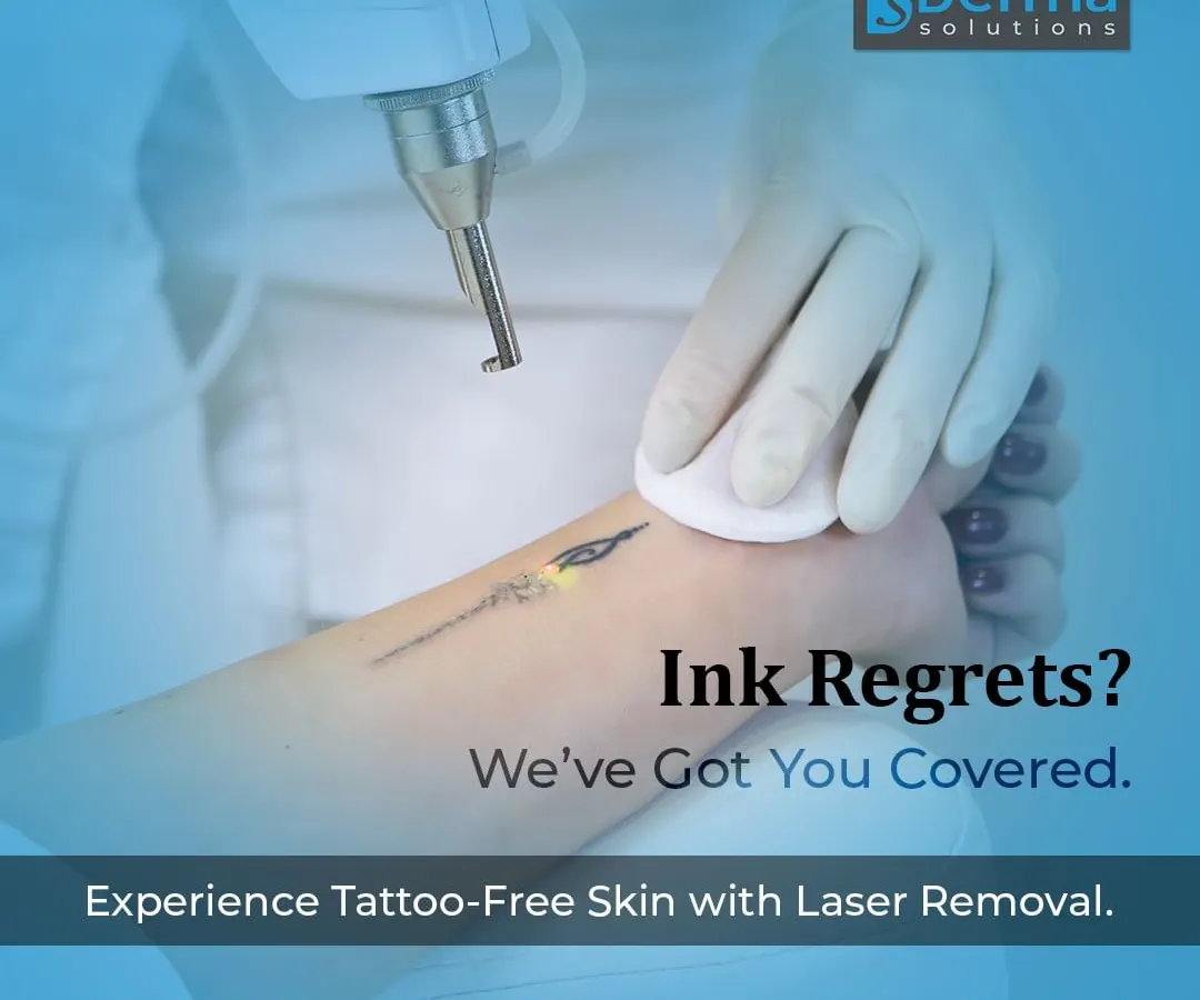Whether your tattoo is large or small, the goal is a clean slate. Here, I am performing a laser removal procedure on a delicate tattoo on the foot. My approach ensures that only the ink is targeted, preserving the health of the surrounding skin.