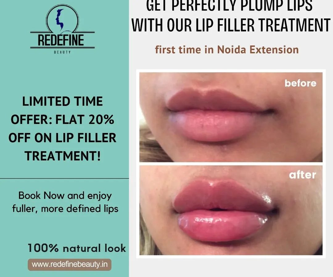 This is a great example of how lip fillers can create a fuller, more defined shape while still looking completely natural. I achieved this plump, hydrated look for a client who wanted to enhance her lips, and the results are immediate.