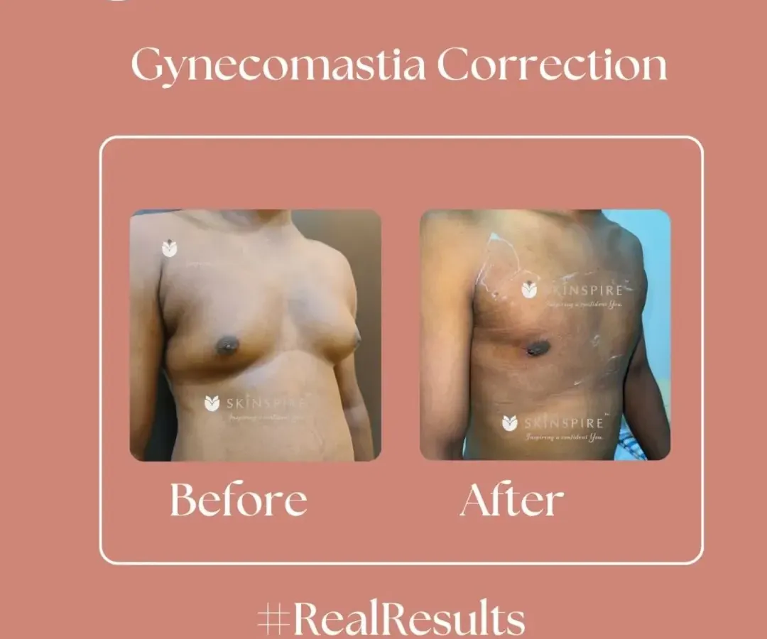 This before and after image shows a gynecomastia correction. For many men, this condition is caused by hormonal factors, not a lack of exercise. Our surgical procedure removes the glandular tissue and excess fat to create a flatter, more masculine chest contour.