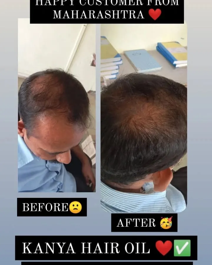 I get many questions about hair regrowth, especially for pattern baldness. This is a real customer result from Maharashtra, showing visible improvement. My Kanya Hair Oil works by nourishing the scalp and stimulating follicles to support natural hair regrowth.