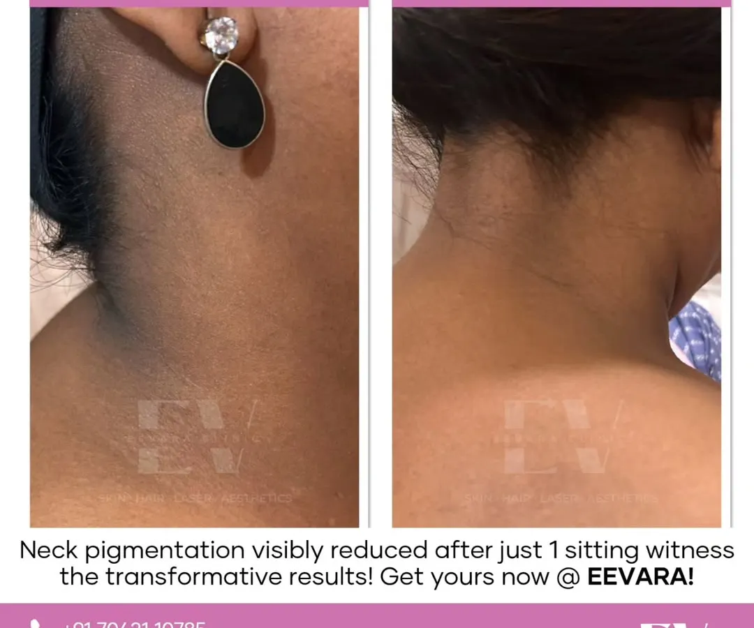 Dark pigmentation on the neck is a common concern, and I address it with targeted treatments. This before and after image shows a visible reduction in neck pigmentation after just one session, helping you feel confident in any wedding outfit.