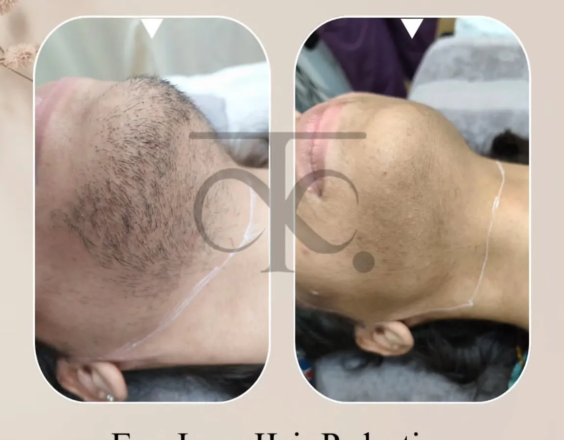 See the clear difference for yourself. This before and after shows the significant reduction in facial hair, leading to smoother skin and renewed confidence for our client.
