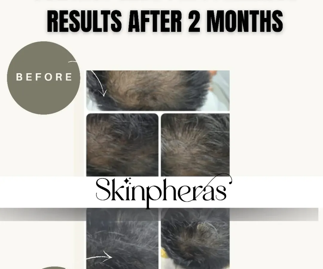 We are proud to be one of the only clinics in Gurgaon offering Contactless PRP with JetPeel technology. This before-and-after image shows significant hair regrowth after just two months, achieved without any needles or pain.