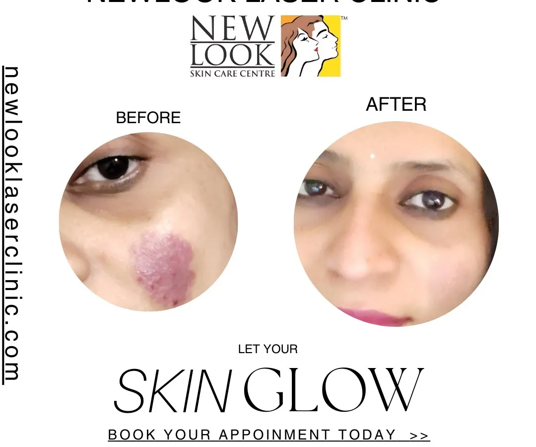 This before and after image showcases the significant reduction of a facial birthmark after treatment at our clinic. Our goal is to help you achieve clearer skin and renewed confidence with personalized dermatology solutions.