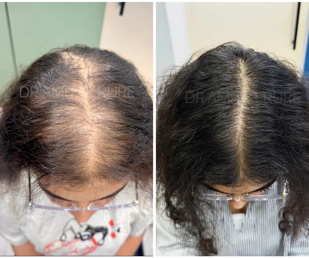 Female pattern hair loss is a common concern, and I treat it with a comprehensive approach. This patient's result was achieved through a combination of PRP and GFC therapy, which are non-surgical treatments that use your body's own growth factors to stimulate hair follicles and restore density. Early diagnosis is key.