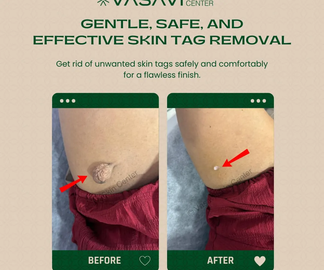 Here you can see a clear before-and-after of a skin tag removal from the underarm area. The procedure is quick, minimally invasive, and the final result is smooth, clear skin with no trace of the previous growth.
