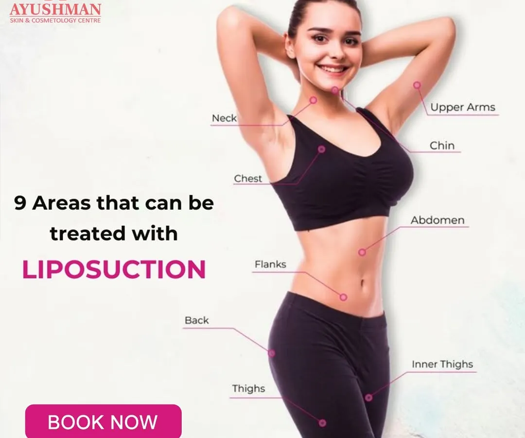 Liposuction is a precise surgical body sculpting tool that can target stubborn fat in up to nine different areas. This visual guide shows the versatility of the procedure, from the abdomen and thighs to the back and upper arms, helping you achieve a comprehensively contoured physique.