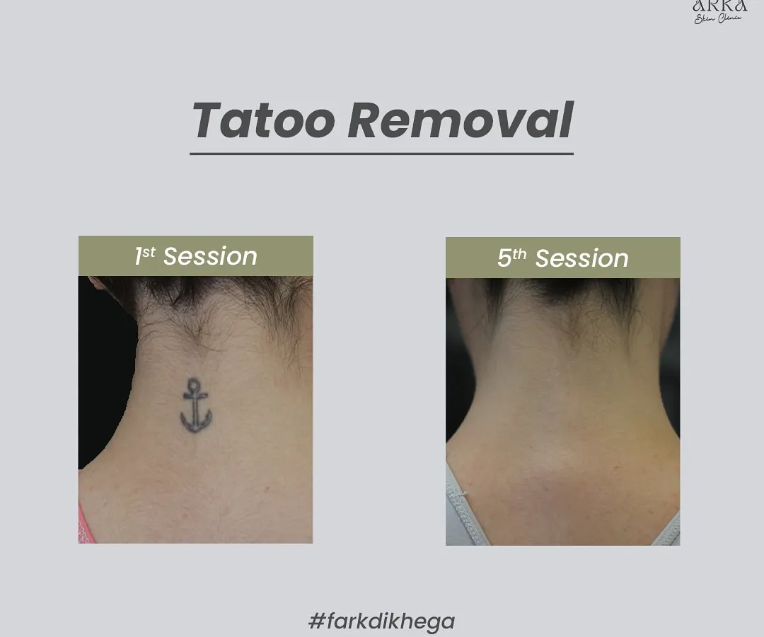 The results speak for themselves. This is the progress after five sessions of our painless laser tattoo removal. We can effectively fade and remove unwanted ink, giving your skin a fresh start.