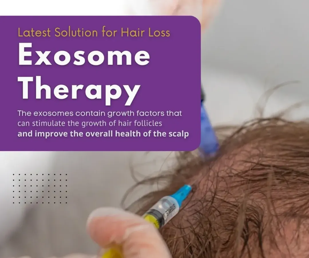 Here you can see the application of Exosome Therapy, one of the latest non-surgical solutions I offer for hair loss. This treatment uses growth factors to stimulate hair follicles and improve the overall health of your scalp, promoting natural regrowth.