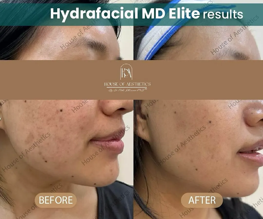 This before-and-after showcases the immediate results of a single Hydrafacial MD Elite session. Notice the visible reduction in pigmentation and uneven texture, and the significant improvement in overall skin clarity and radiance. This is the kind of healthy, hydrated glow you can expect.