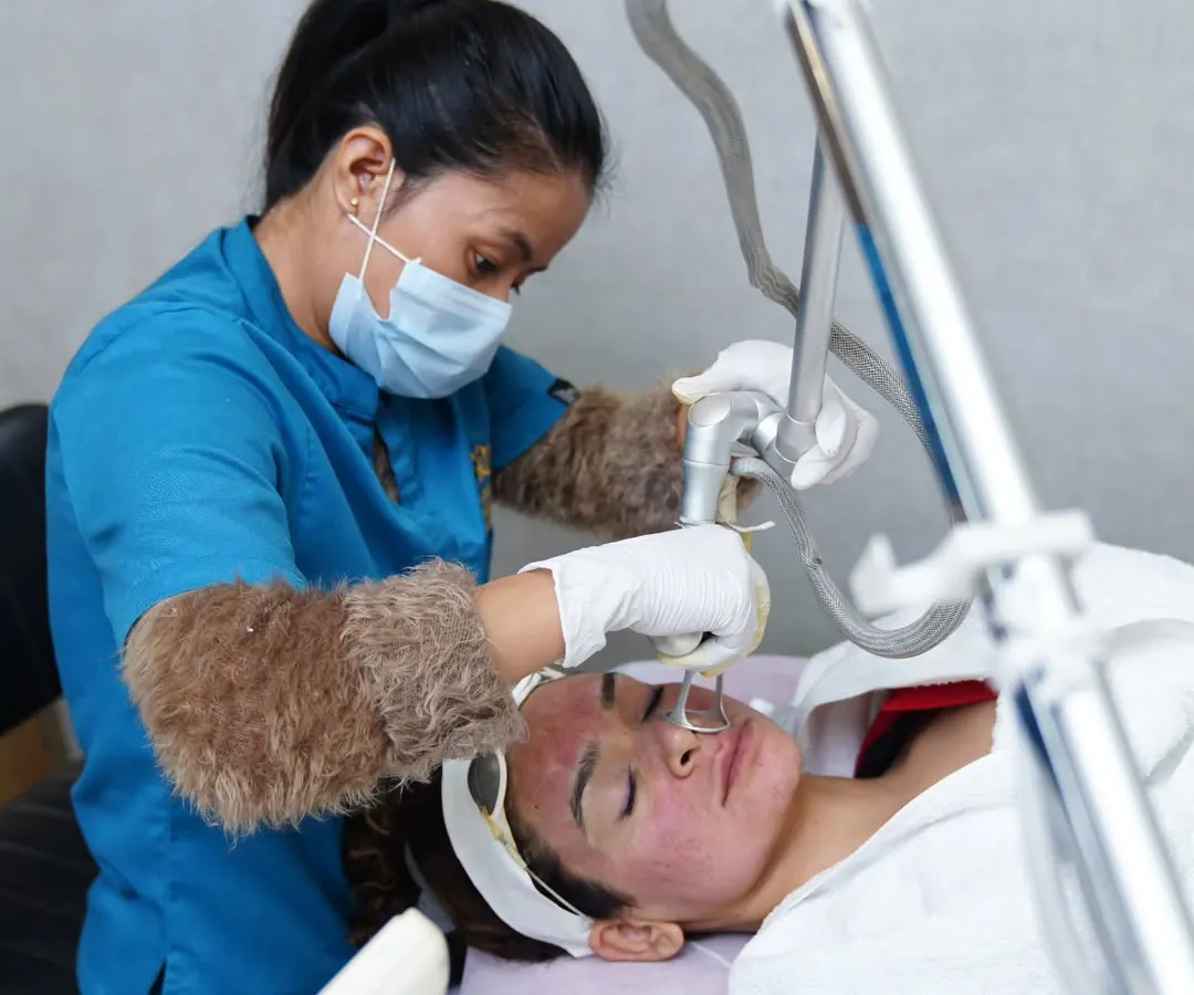 Here you can see our expert therapist performing a fractional laser treatment. This advanced, US-FDA approved technology is one of our primary tools for treating concerns like acne scars, fine lines, and uneven skin texture by stimulating collagen deep within the skin.