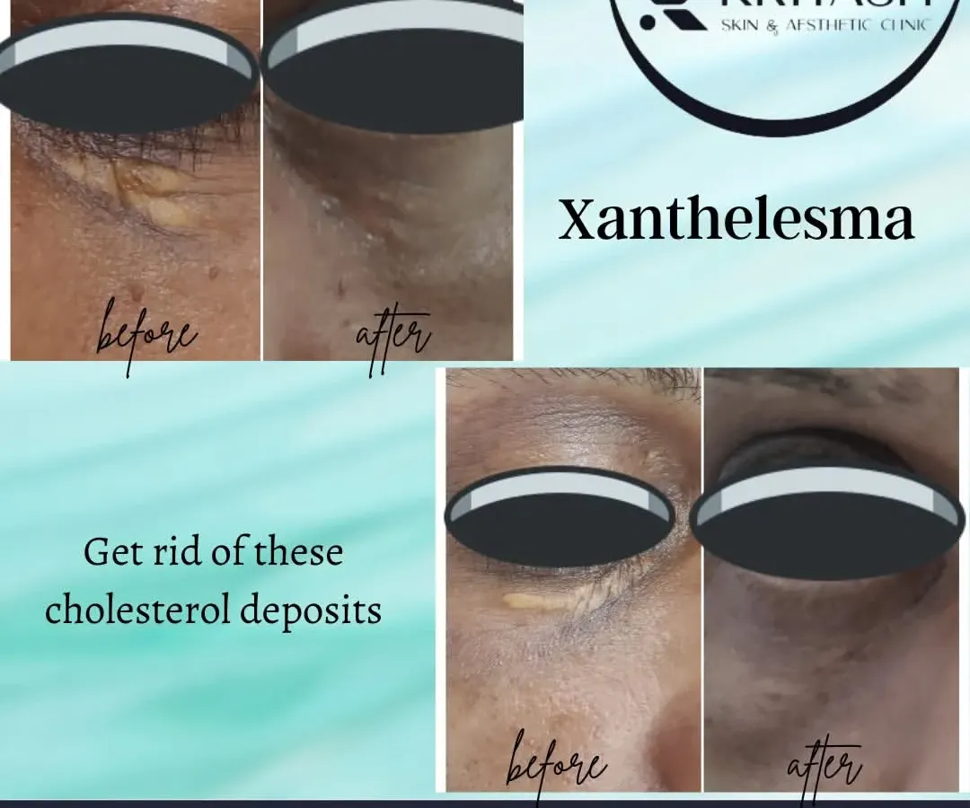 Here I have treated xanthelasma, the yellowish cholesterol deposits that appear on or near the eyelids. The images clearly show the significant cosmetic improvement after the deposits were carefully removed. I use various methods like laser, radiofrequency ablation, or peels, depending on your specific case.