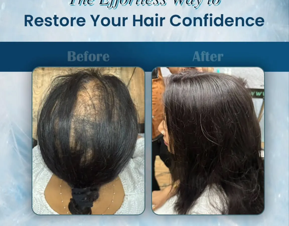 For our female clients experiencing hair thinning on the top of their scalp, we provide custom hair toppers. This before and after photo shows how we restored volume and coverage instantly, creating a natural-looking hairline with a pain-free solution.