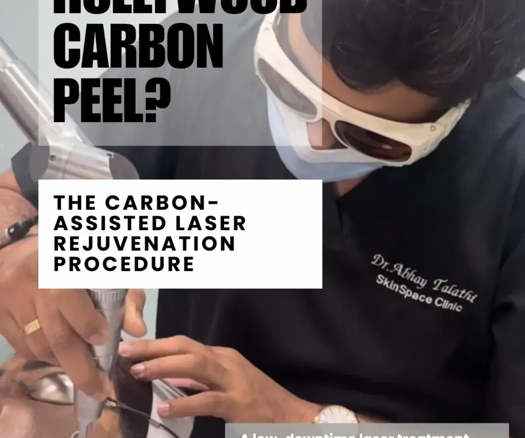 Here, Dr. Abhay Talathi is performing our popular Hollywood Carbon Peel. This procedure is a carbon-assisted laser rejuvenation treatment that we use to target oil, pigment, and texture for instantly brighter skin with low downtime. It showcases our hands-on, expert-led approach to skincare.