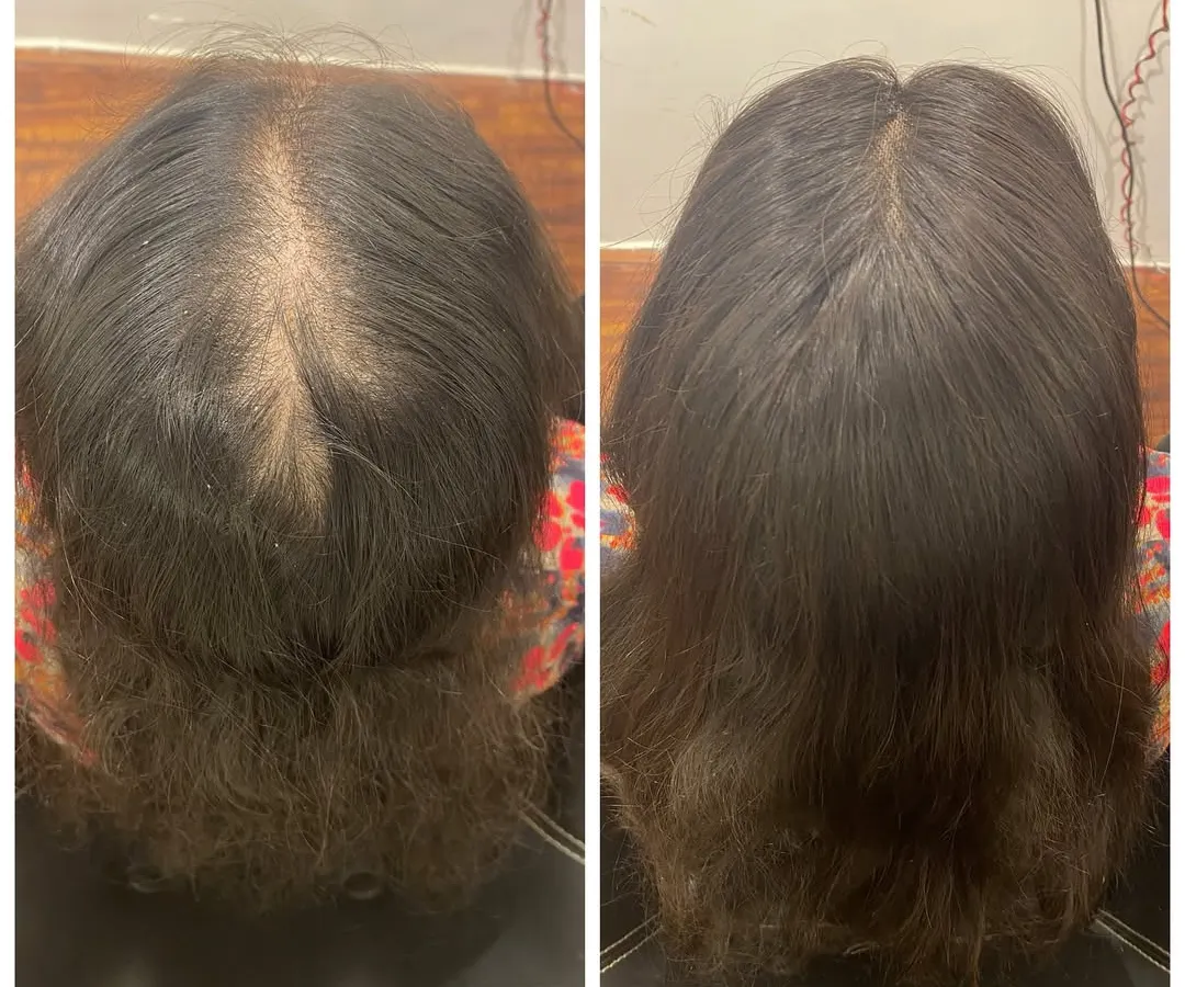 This before and after shows the effectiveness of our custom crown topper. It is designed to conceal hair thinning at the crown, blending perfectly with the client's natural hair for a fuller, more confident appearance.