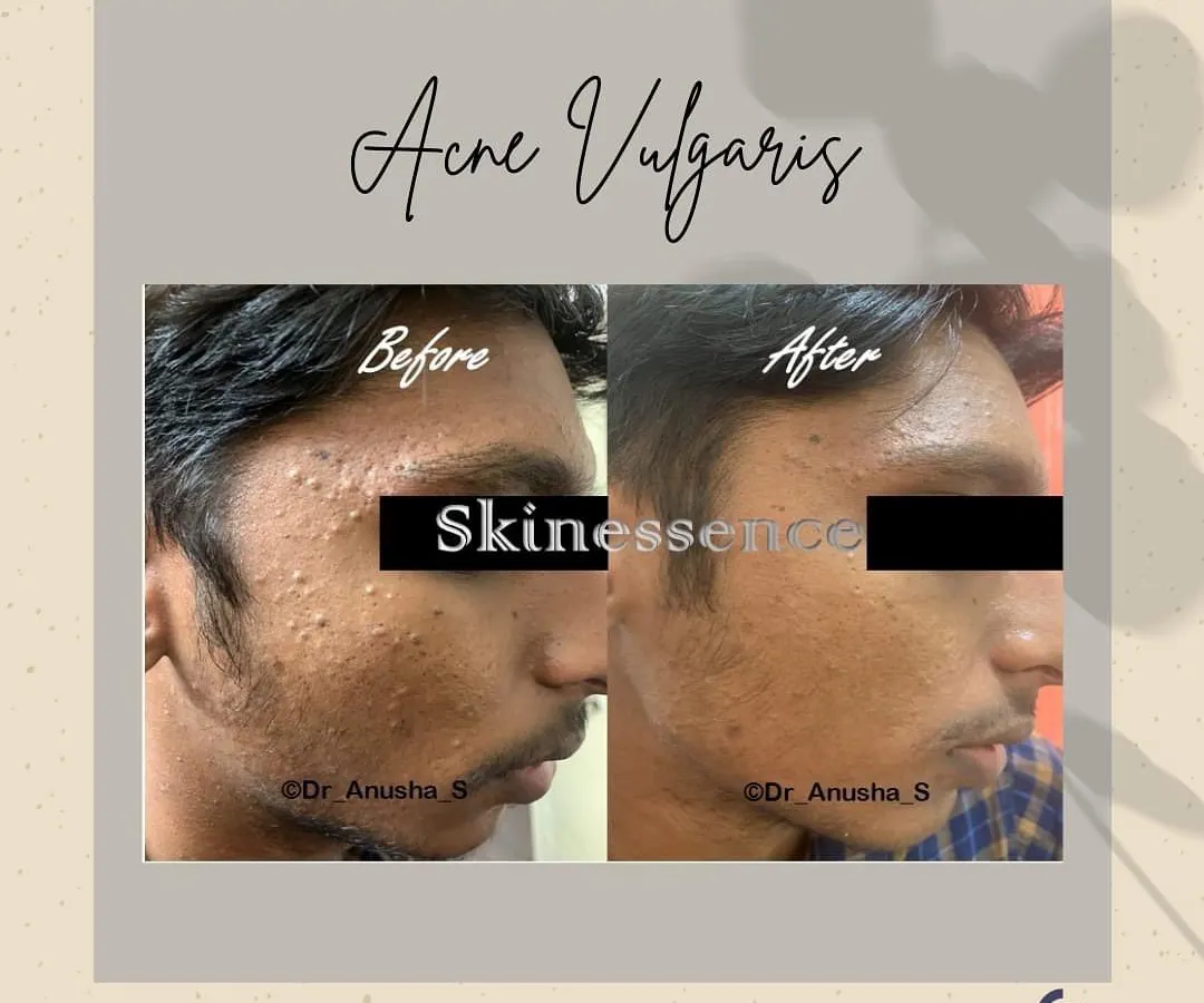 Here you can see a clear improvement in active acne and post-inflammatory marks after just 8-12 weeks of a consistent, medically supervised treatment plan. My approach focuses on controlling breakouts and preventing future scarring.