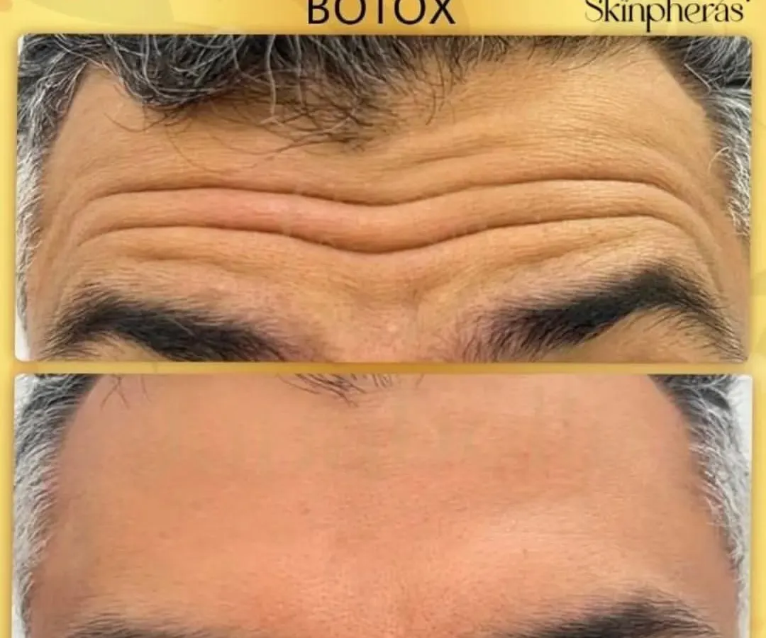 This before and after image shows the effectiveness of Botox in smoothing deep-set forehead lines. The treatment relaxes the underlying muscles, resulting in a significantly smoother and more youthful appearance.
