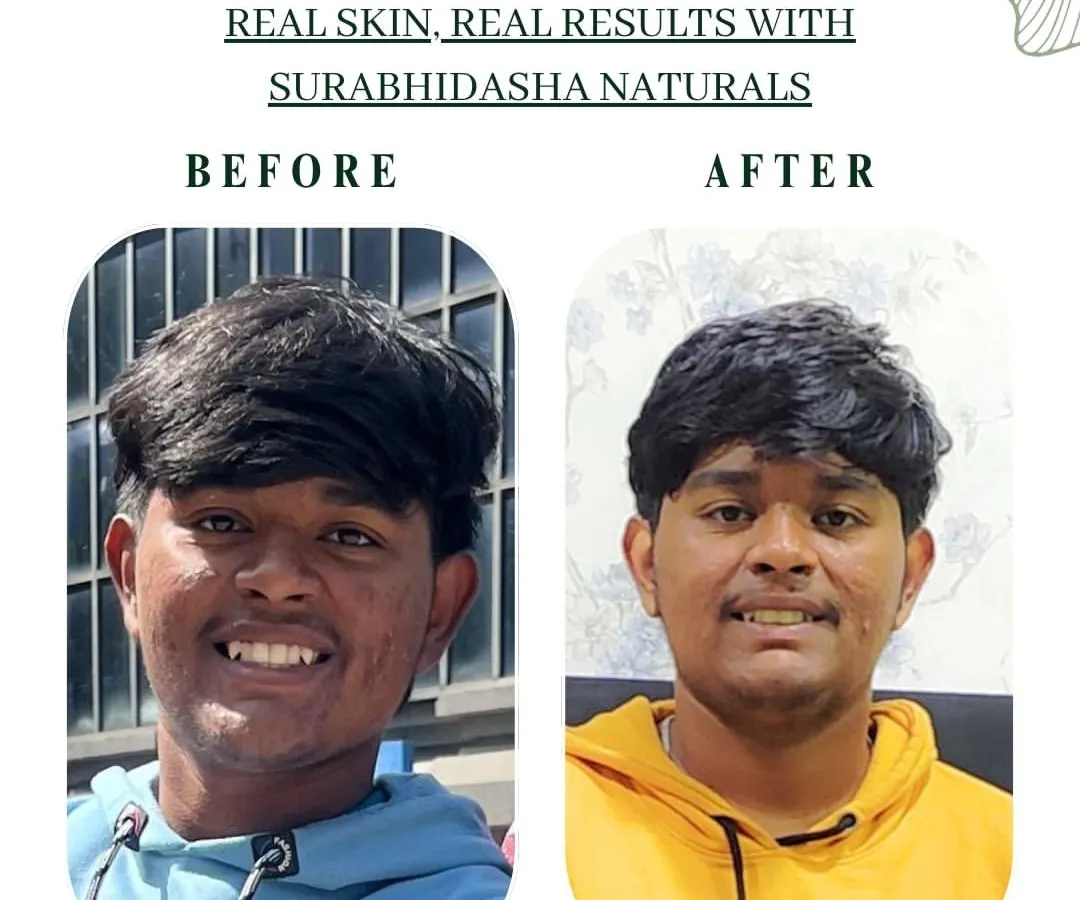 This is why I do what I do. Seeing real transformations like this client's journey from dealing with acne to enjoying clear, healthy skin is my greatest reward. It’s proof that gentle, natural ingredients can truly heal.