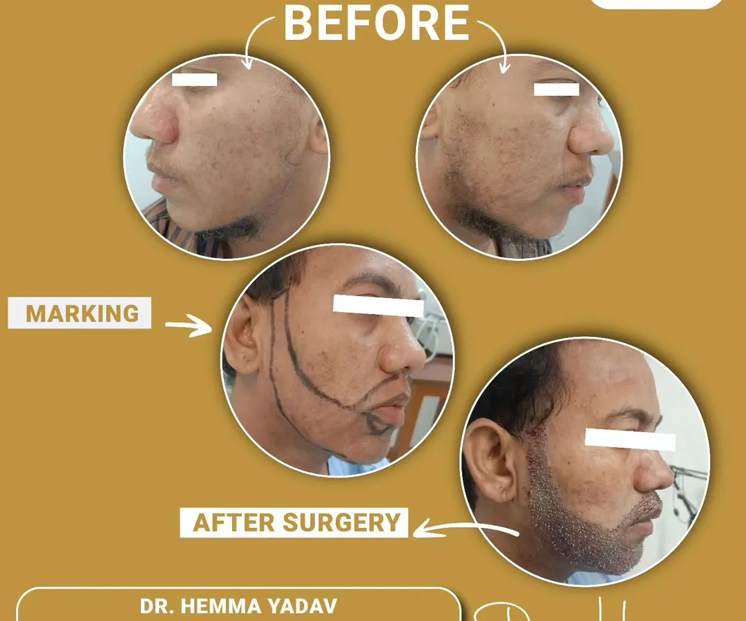 A beard transplant is a journey to renewed confidence. This image shows the key stages of the process, from the initial consultation and precise markings for the new hairline, to the final, dense beard growth after the procedure. I design the shape to perfectly suit your facial structure.