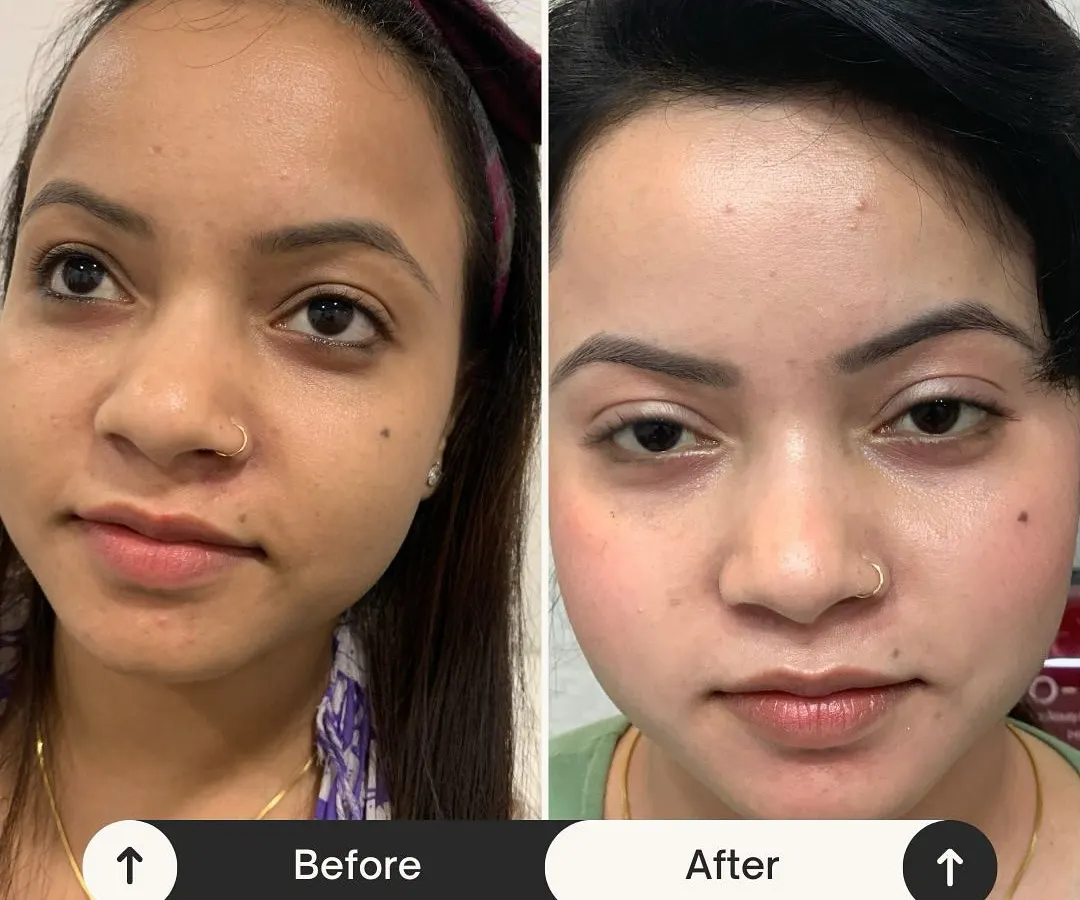 Witness the power of my Miracle Facial in just one session. This before and after shows a dramatic improvement in skin clarity, texture, and overall radiance. My goal is to give you skin that feels so good, you need less makeup to feel confident.