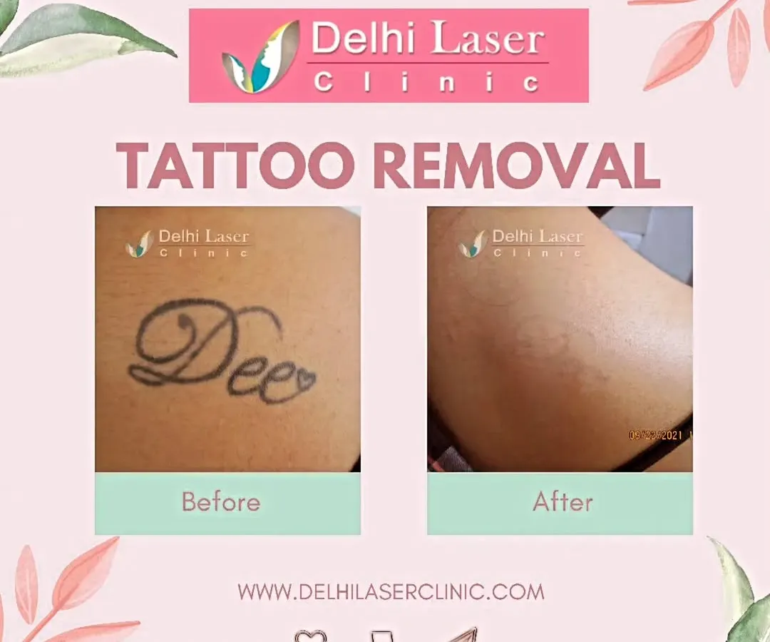 Here is a clear before and after from a laser tattoo removal treatment. We used our US FDA-approved Medlite C6 Q-Switch laser to break down the ink particles over several sessions, resulting in the tattoo fading completely and leaving clear skin.