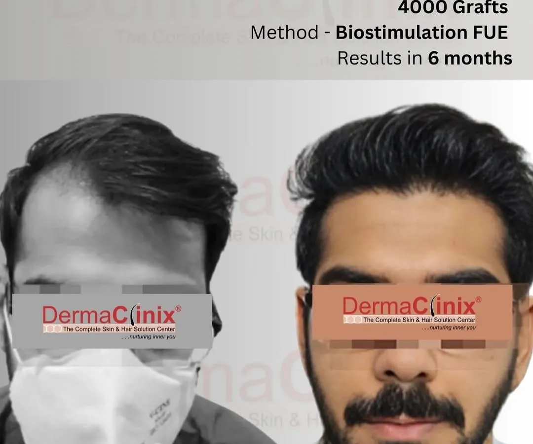 This is a clear example of what's possible with our Biostimulation FUE method. This patient received 4000 grafts, and this is the significant regrowth and density achieved in just six months.