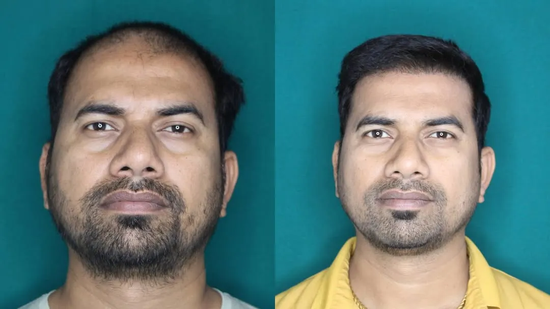 A strong hairline frames the face and restores a youthful appearance. For this patient, I focused on rebuilding his receding hairline and adding density to the frontal region. The result is a natural-looking frame for his face that boosts his confidence.