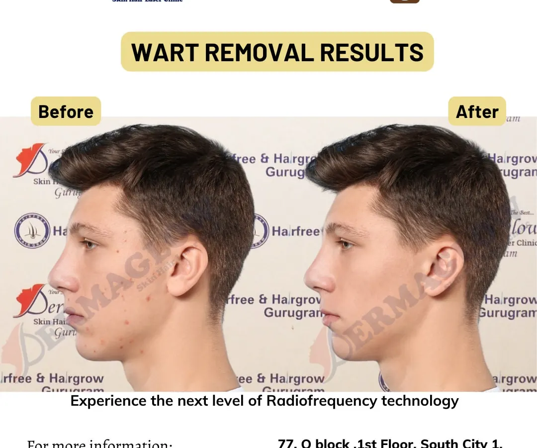 Notice the complete clearance of facial warts in this before-and-after comparison. Our procedure is designed to be effective and gentle, leaving behind smoother skin with minimal signs of the previous blemishes.