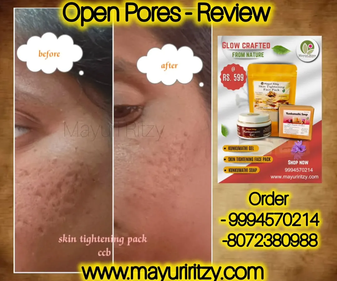 Many of you ask me about open pores, and here is the result you can expect. This is a real customer's 'before and after' photo after using my skin tightening pack. You can see how the pores have visibly reduced, making the skin look smoother and clearer.