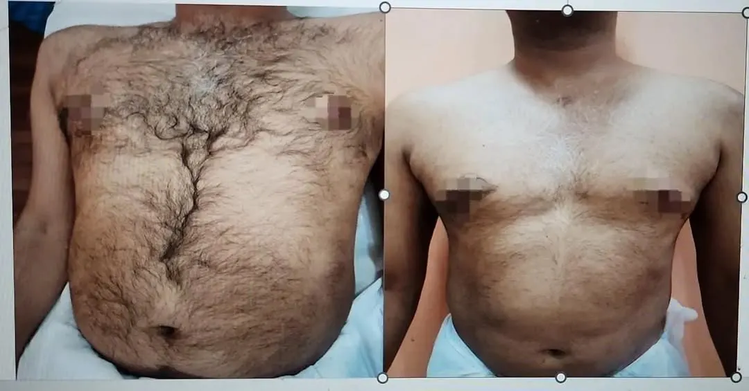 This before and after image shows the results of laser hair reduction on the chest for a male patient after just a few sessions. My advanced dual-wavelength laser offers effective and comfortable hair reduction for various skin and hair types, for both men and women.