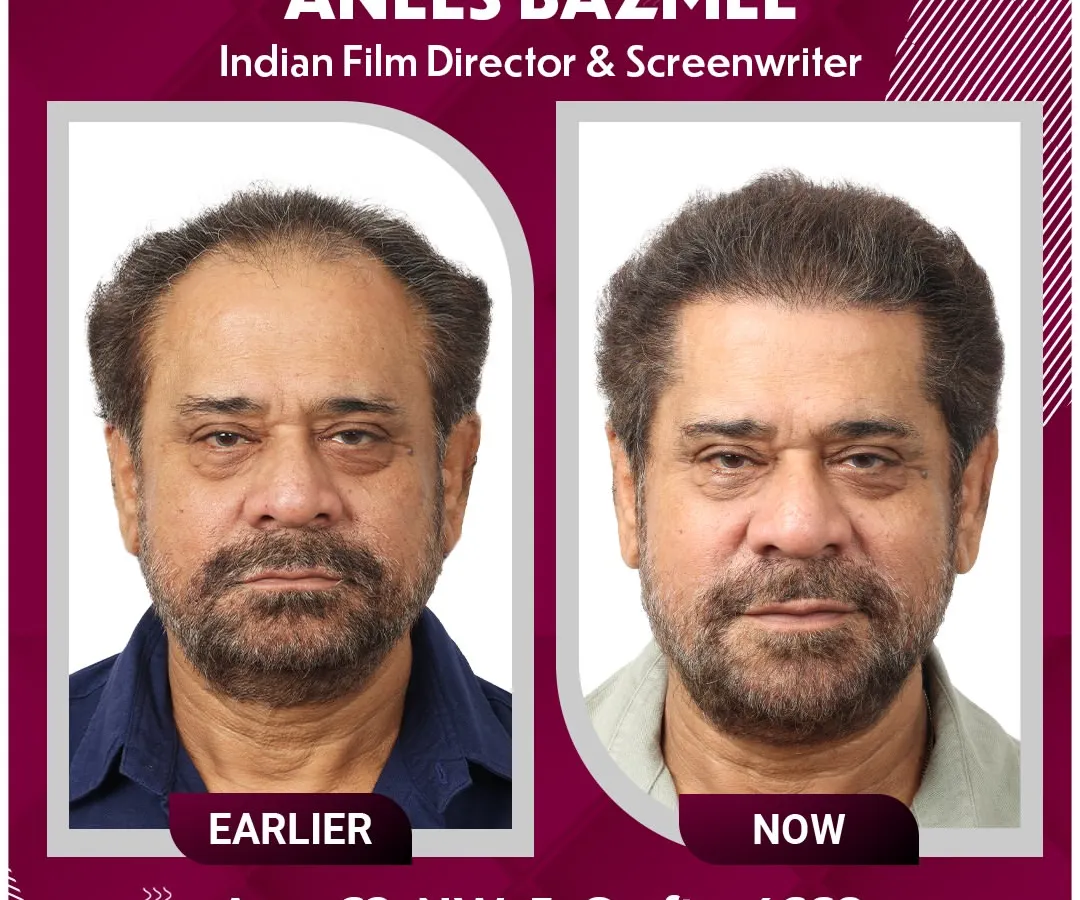 We are proud to be the choice of icons. Here is the remarkable transformation of esteemed Indian Film Director, Anees Bazmee. We addressed his Grade 5 hair loss with 4,668 grafts, creating a result that is as masterful as his films.