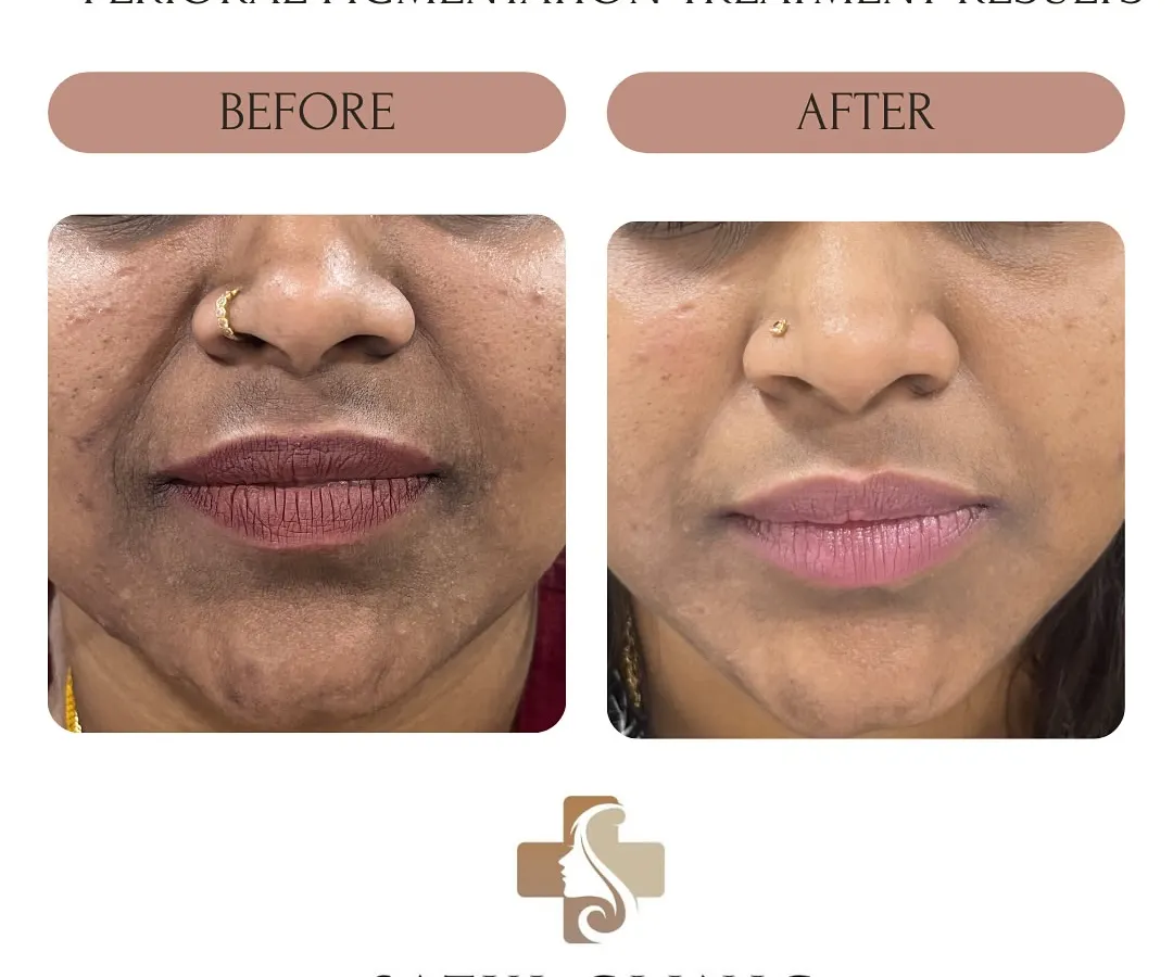 This patient was treated for Perioral Melanosis, which is the clinical term for darkening of the skin around the mouth. You can see a visible lightening of the hyperpigmentation and a more even skin tone after a course of dermatologist-guided depigmenting therapy and a strict sun protection regimen.