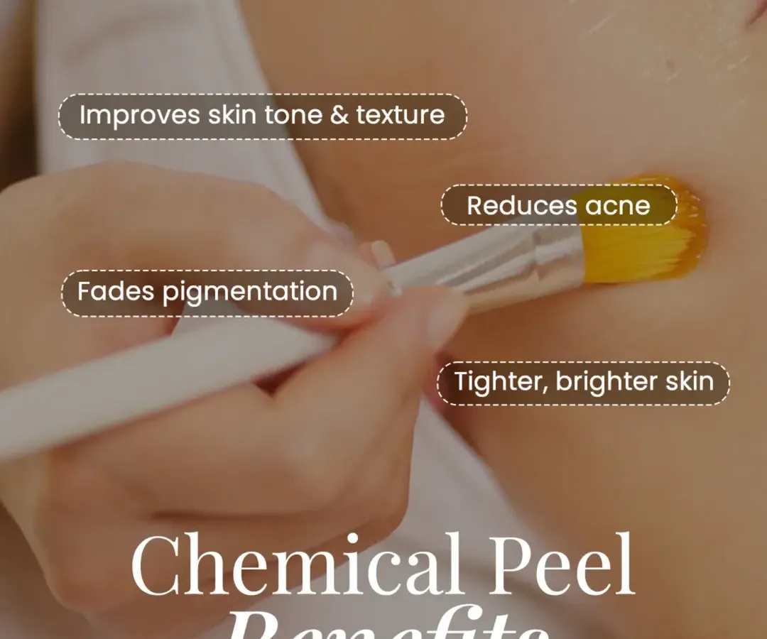 A chemical peel is a powerful tool for skin renewal, as shown in this treatment application. I use specific formulations to improve skin tone and texture, reduce active acne, fade post-inflammatory pigmentation, and reveal tighter, brighter skin.