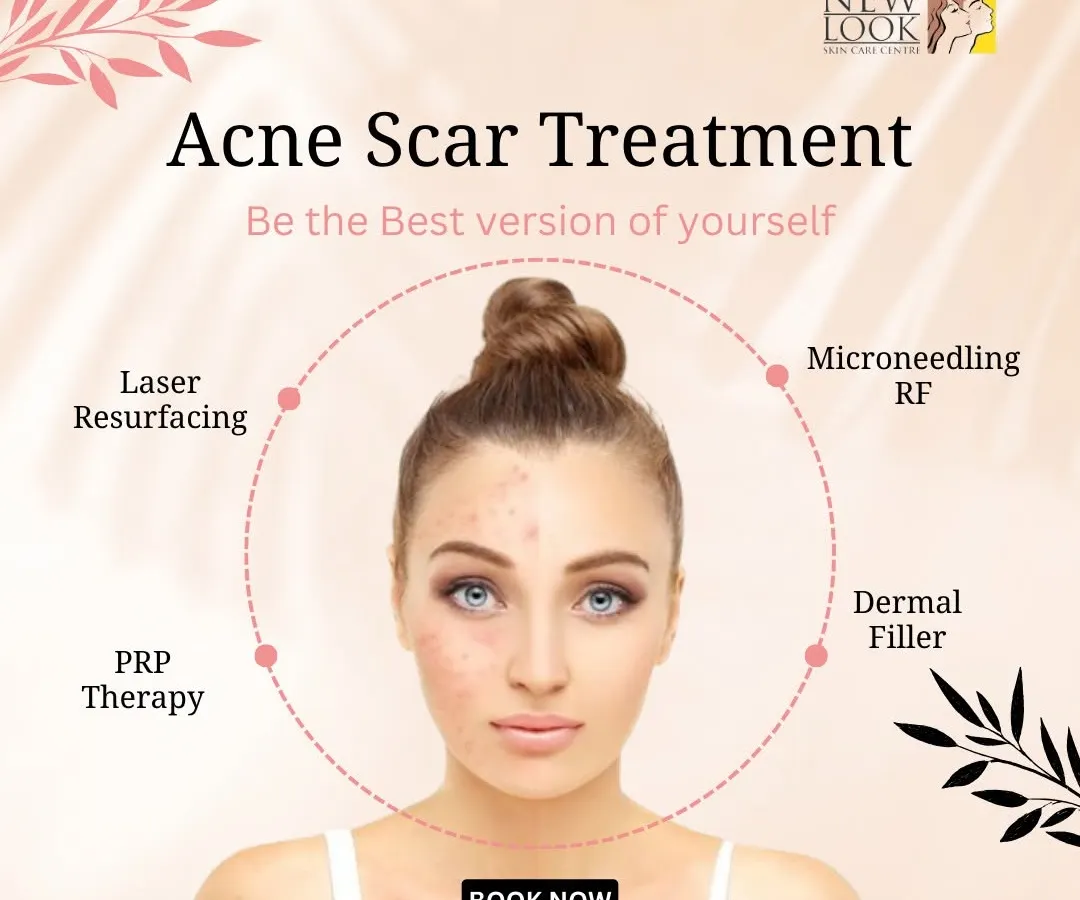 We offer a comprehensive range of solutions for acne scars, because no two skin types are the same. This visual outlines some of our most effective approaches, including Laser Resurfacing, Microneedling RF, PRP Therapy, and Dermal Fillers, all tailored to your specific needs after a thorough skin analysis.