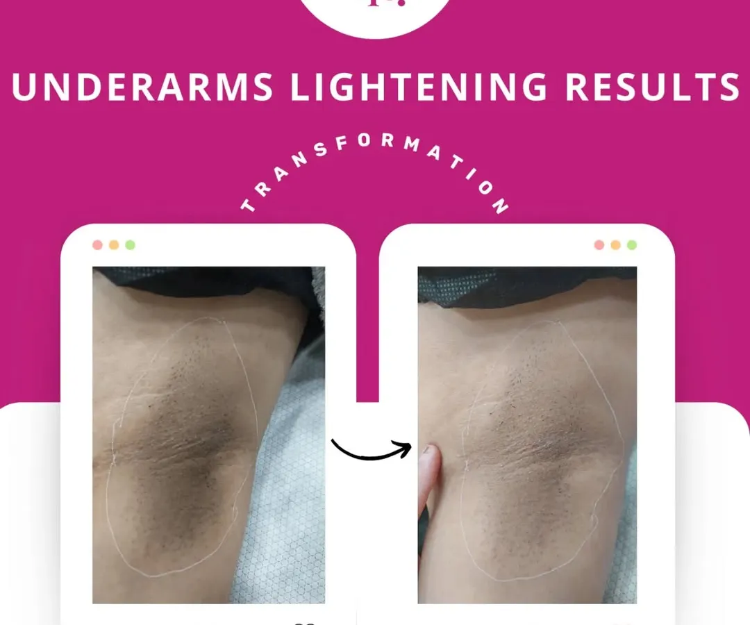 This is a real result from my underarm lightening treatment. Using a gentle, customized chemical peel, we can significantly reduce pigmentation over a few sessions, helping you feel confident enough to wear whatever you want. No harsh bleach, just a safe and effective process.